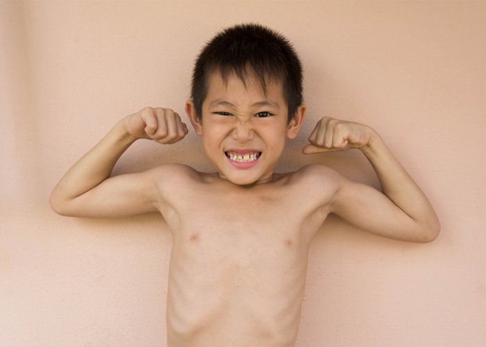 Suy dinh dưỡng diễn ra phổ biến ở trẻ em do ảnh hưởng của khí thải nhà kính