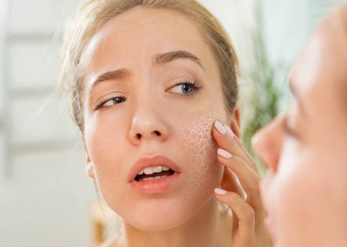 Thời tiết hanh khô khiến da bị khô nứt nẻ