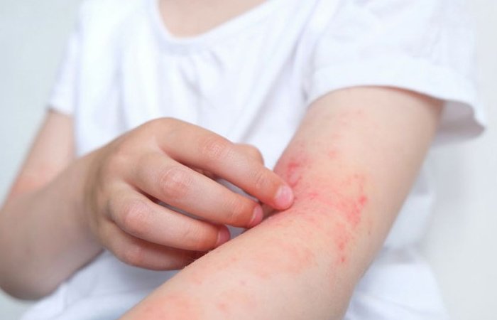 Thời điểm giao mùa khiến nhiều người dễ bị dị ứng thời tiết